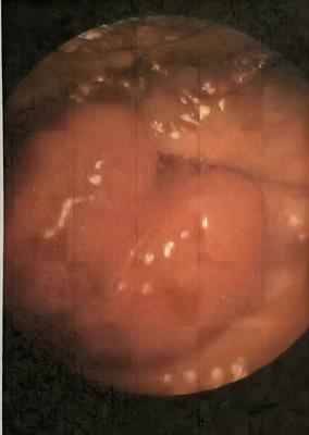 Case Report: Plasmacytoma of External Urethral Meatus